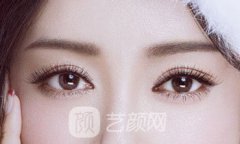 成都埋线双眼皮需要多少钱呢?