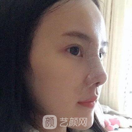 重庆联合丽格王岩玻尿酸隆鼻三个月了，分享果照片~