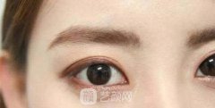 用自体脂肪丰卧蚕会不会被吸收啊