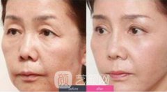 提眉的副作用有哪些