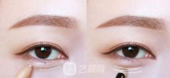 人工卧蚕整形术优缺点?