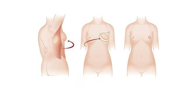 什么是乳房再造?谁是乳房再造的候选人?