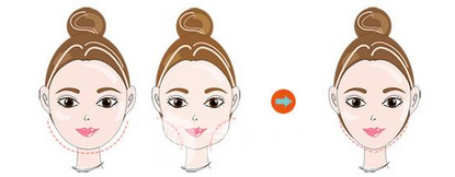 吸脂瘦脸术后怎么护理?