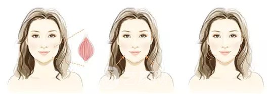 打注射瘦脸有副作用吗?