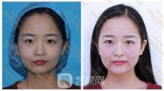 胶原蛋白丰下巴有哪些优势？