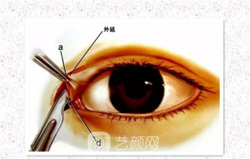 开内眼角多少钱？