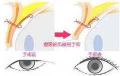 眼睑外翻矫正的原理方法是什么？
