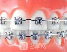 3d牙齿矫正技术怎么样?果好不好?