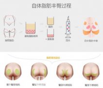 自体脂肪丰臀多少钱？