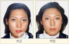 假体丰太阳穴多少钱？