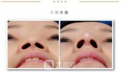 鼻孔矫正多少钱？鼻孔矫正手术贵不贵？