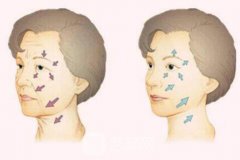 伊维兰除皱价格贵不贵?伊维兰除皱价格多少钱?