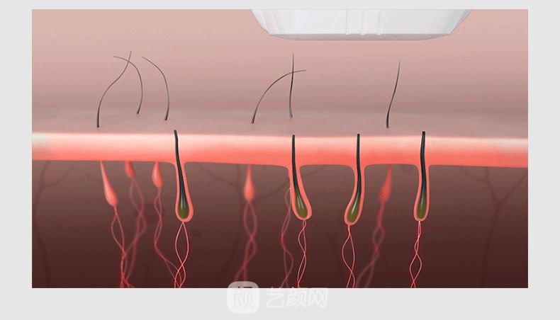 激光脱毛多少钱？