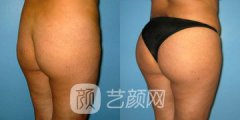 巴西提臀术价格多少？巴西提臀术价格影响因素