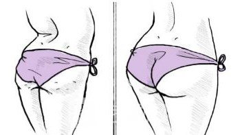 什么是巴西提臀术？巴西提臀术适应人群有哪些？