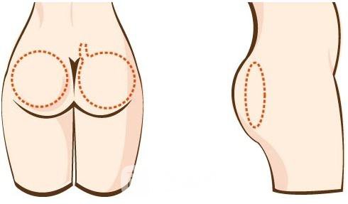 巴西提臀术多久能恢复?巴西提升术能修复吗?