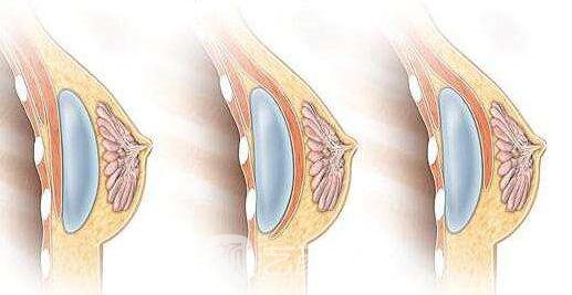 【隆胸多久可以穿胸罩？乳房植入物能保持多久?】