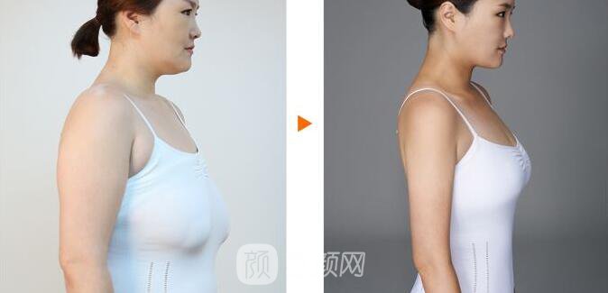 【什么是乳房缩小术？乳房缩小价格多少？】
