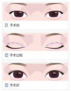 生物焊接双眼皮价格多少?生物焊接双眼皮价格影响因素是什么呢?