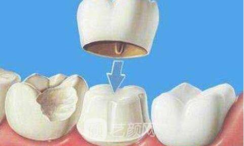 【3d美牙冠果咋样?3d美牙冠果】