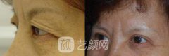 天津上眼睑去脂多少钱，影响天津上眼睑去脂多少钱的因素