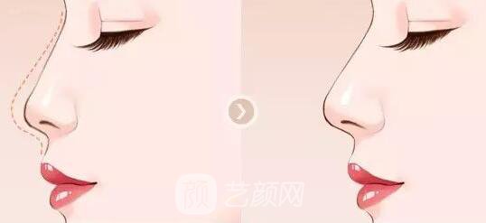 【隆鼻多久能恢复?隆鼻恢复时间是多长?】