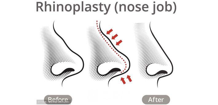 【隆鼻术后注意什么?隆鼻术后注意事项有哪些?】