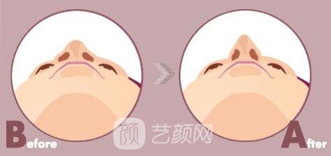 【假体隆鼻恢复时间是多长?假体隆鼻有多久的恢复期?】