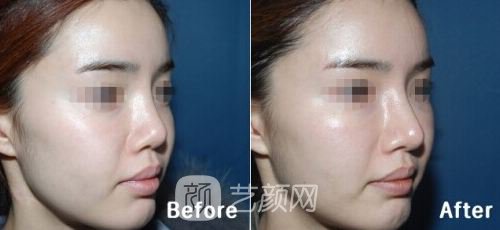 【自体脂肪隆鼻术后注意哪些?自体脂肪隆鼻术后有哪些注意事项?】