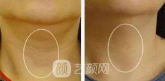北京颈部除皱多少钱?价格方面受到哪些因素影响呢?