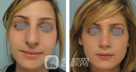 【隆鼻手术后多久消肿?隆鼻手术后如何消肿?】