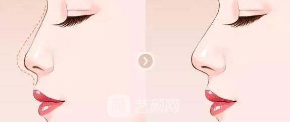 微晶瓷注射隆鼻