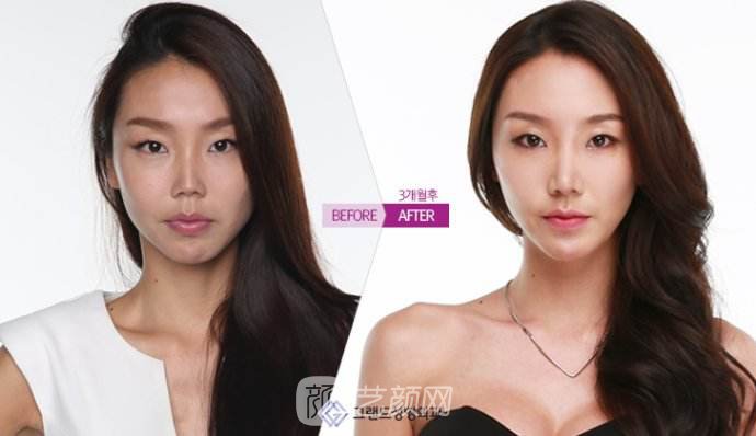 【隆鼻术后肿胀多久？隆鼻术后多长的肿胀期？】