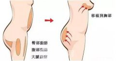 北京吸脂隆胸价格多少？北京吸脂隆胸价格影响因素