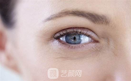 上眼睑去脂肪多久恢复?上眼睑去脂肪恢复期有多久?