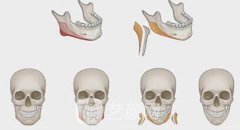 去下颌角的费用多少？去下颌角的费用影响因素