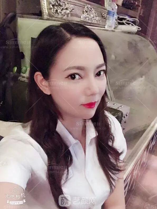 上海喜美全肋鼻修复+鼻头缩小+鼻小柱后缩矫正案例~