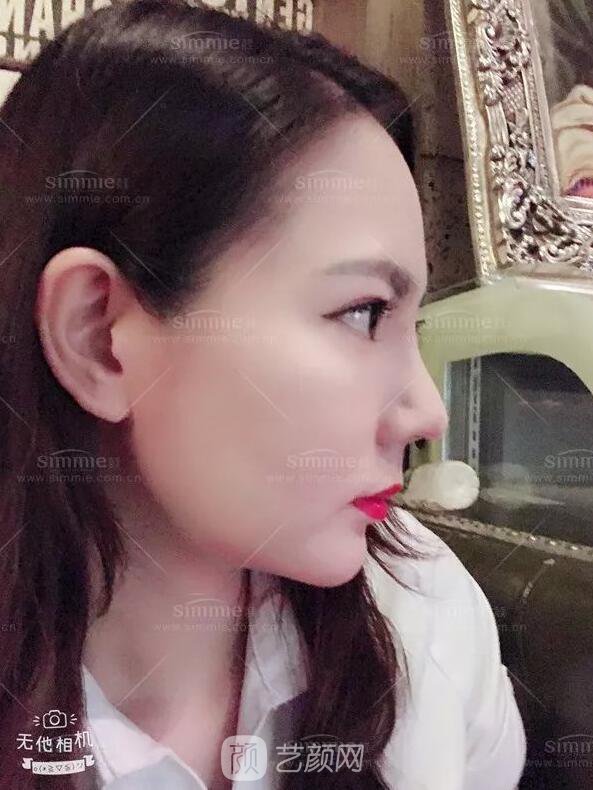 上海喜美全肋鼻修复+鼻头缩小+鼻小柱后缩矫正案例~