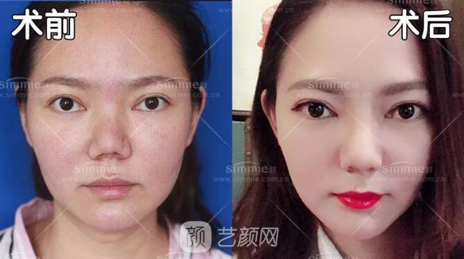 上海喜美全肋鼻修复+鼻头缩小+鼻小柱后缩矫正案例~