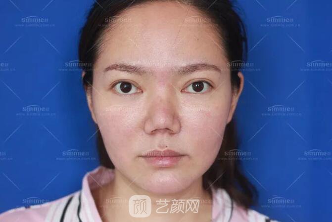 上海喜美全肋鼻修复+鼻头缩小+鼻小柱后缩矫正案例~