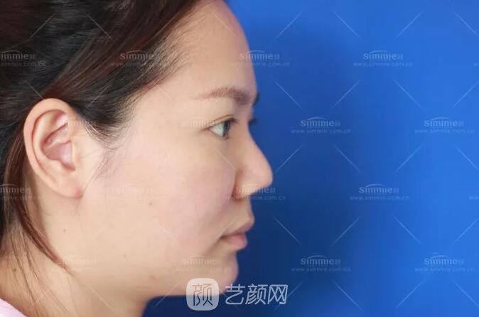 上海喜美全肋鼻修复+鼻头缩小+鼻小柱后缩矫正案例~