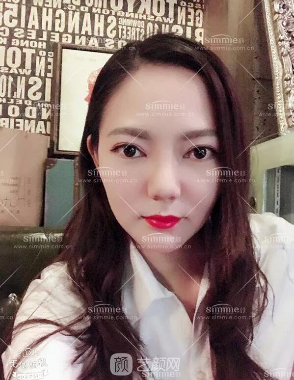 上海喜美全肋鼻修复+鼻头缩小+鼻小柱后缩矫正案例~