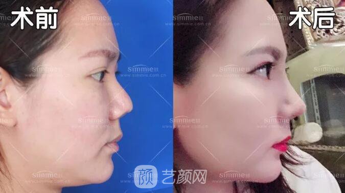 上海喜美全肋鼻修复+鼻头缩小+鼻小柱后缩矫正案例~