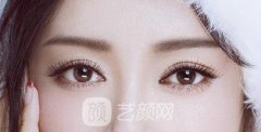 上海高分子埋线双眼皮多少钱？