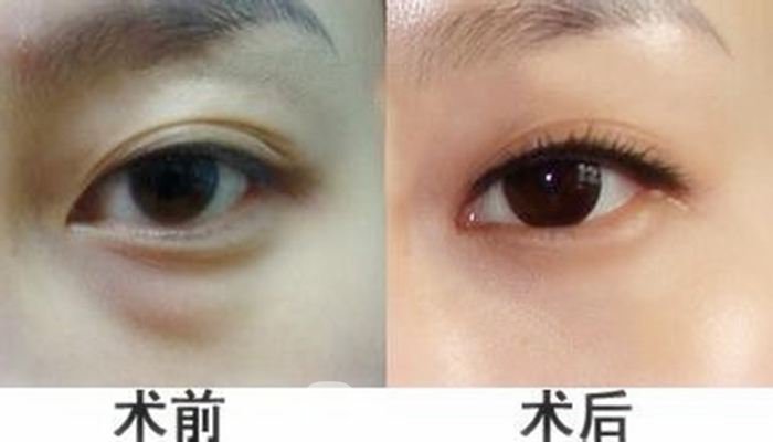 激光祛眼袋有优势吗？有哪些优势？