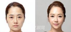 深圳磨腮削骨多少钱？磨腮削骨多少钱和哪些因素有关？