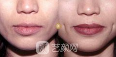 人造酒窝价格多少?人造酒窝价格影响因素~