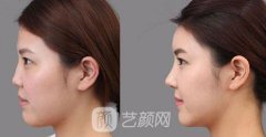 骨粉隆鼻价格多少？骨粉隆鼻价格影响因素有哪些？