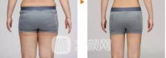 环形吸脂价格要多少钱？环形吸脂价格影响因素~