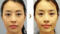悬吊除皱术去法令纹多少钱?